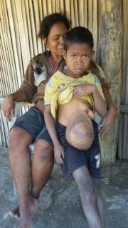 Melki, bocah 11 tahun mengalami kelainan di bagian perut sedang bersama ibunya Anggelina Abuk
